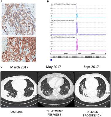 Precision Medicine Tools to Guide Therapy and Monitor Response to Treatment in a HER-2+ Gastric Cancer Patient: Case Report